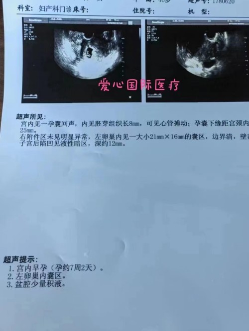 2022.8.24好孕：高龄试管一超顺利出胎心