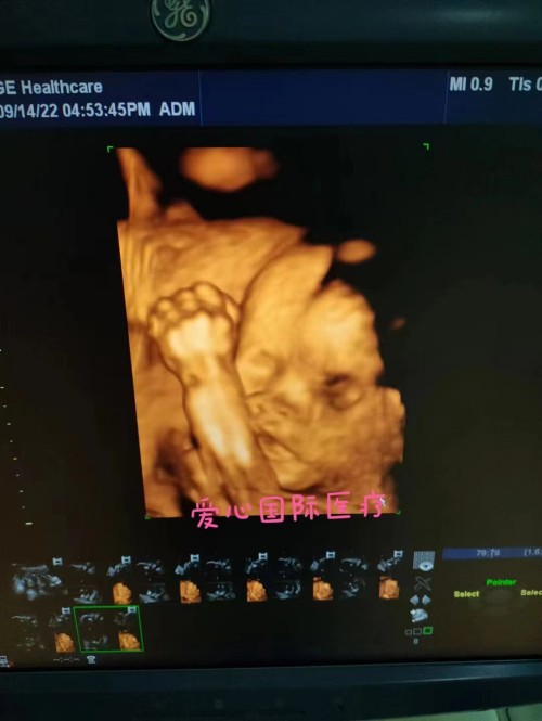 2022.9.15好孕来了：高龄试管接宝宝5个月啦(图2)