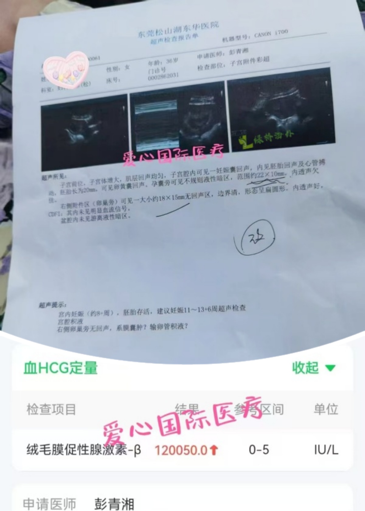 2025.5.23孕8周+，胎心胚芽长的很好
